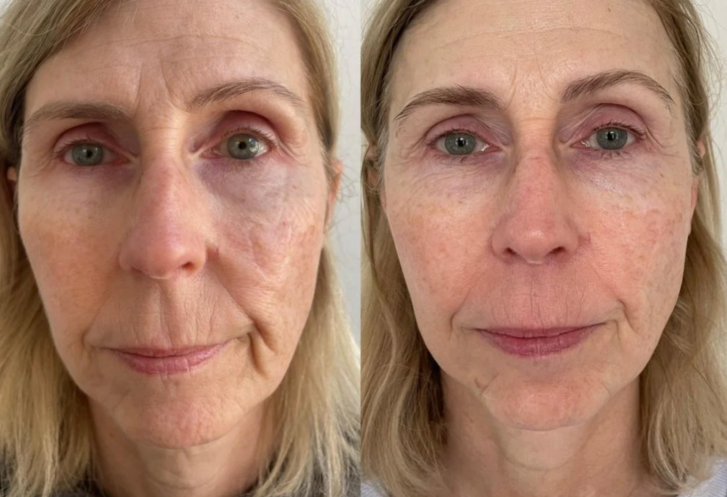 KrX Youthplex Face Lift Toning Solution